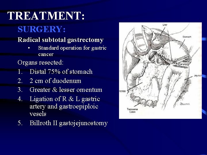 TREATMENT: SURGERY: Radical subtotal gastrectomy • Standard operation for gastric cancer Organs resected: 1.