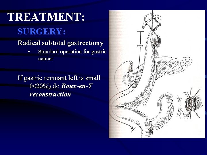 TREATMENT: SURGERY: Radical subtotal gastrectomy • Standard operation for gastric cancer If gastric remnant