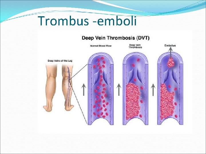 Trombus -emboli 