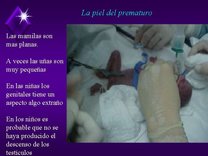 La piel del prematuro Las mamilas son mas planas. A veces las uñas son