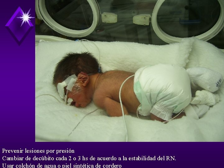Prevenir lesiones por presión Cambiar de decúbito cada 2 o 3 hs de acuerdo