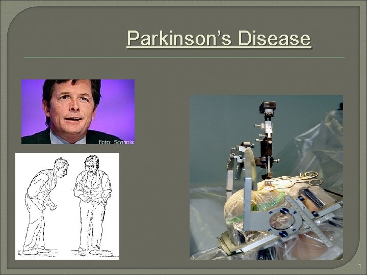 Parkinson’s Disease 1 