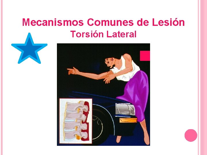 Mecanismos Comunes de Lesión Torsión Lateral 