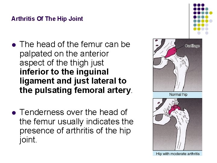 Arthritis Of The Hip Joint l The head of the femur can be palpated