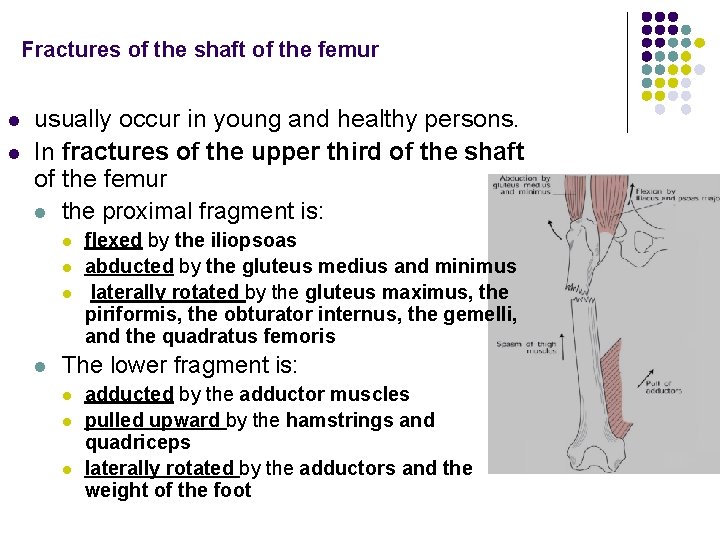 Fractures of the shaft of the femur l l usually occur in young and