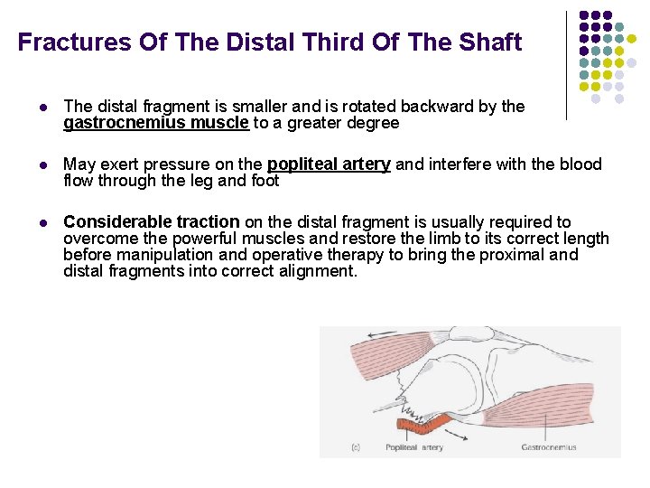 Fractures Of The Distal Third Of The Shaft l The distal fragment is smaller
