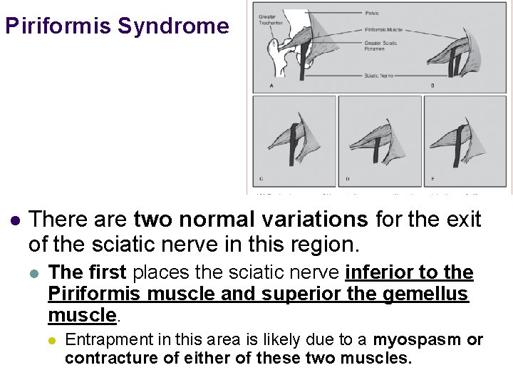 Piriformis Syndrome l There are two normal variations for the exit of the sciatic