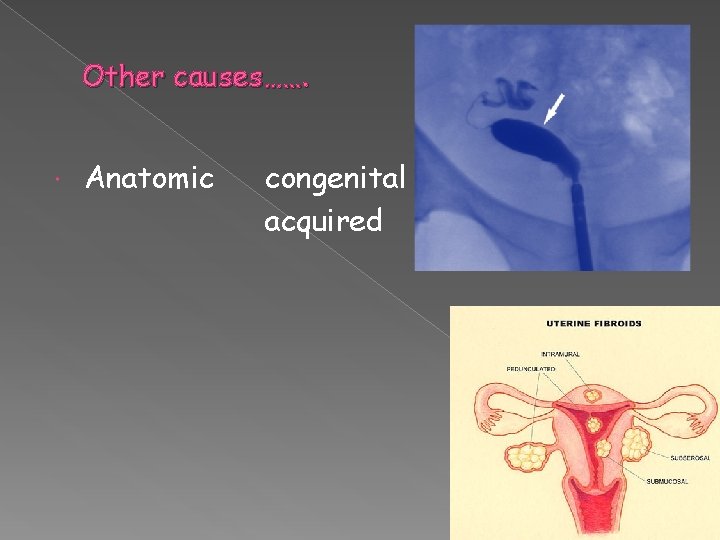 Other causes……. Anatomic congenital acquired 