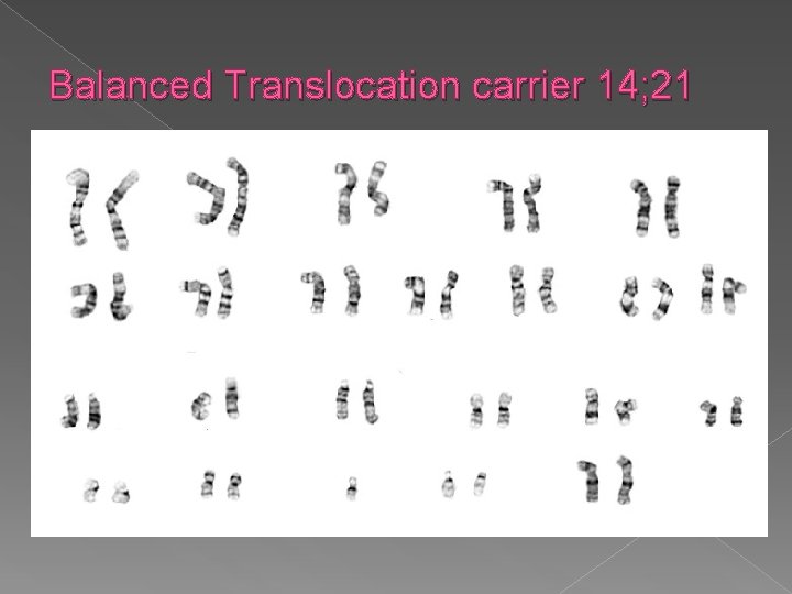 Balanced Translocation carrier 14; 21 