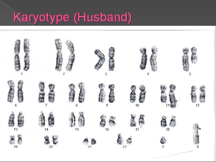 Karyotype (Husband) 