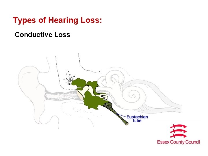 Types of Hearing Loss: Conductive Loss 