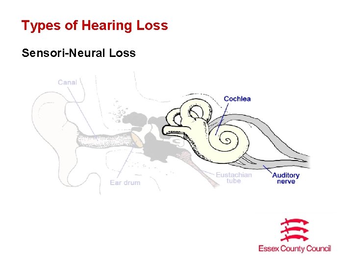 Types of Hearing Loss Sensori-Neural Loss 