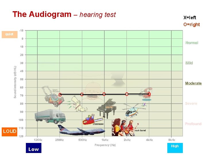 The Audiogram – hearing test X=left O=right quiet O O O LOUD Low High