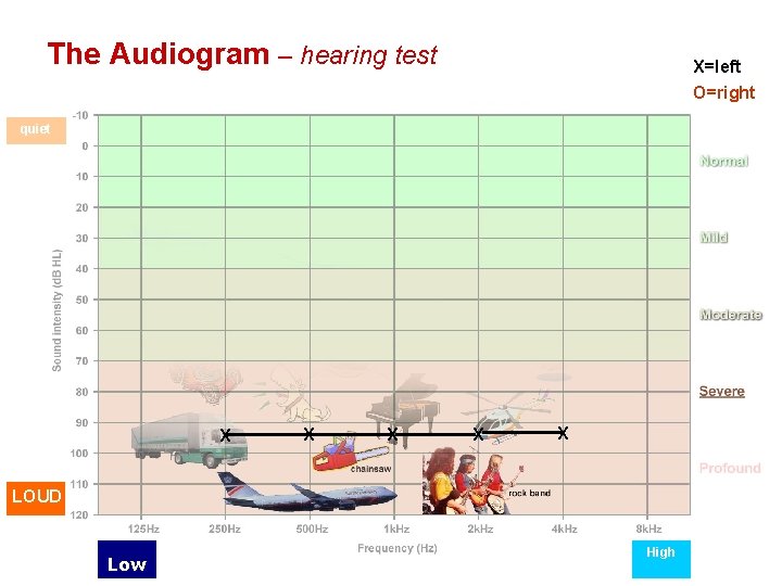 The Audiogram – hearing test X=left O=right quiet X X X LOUD Low High