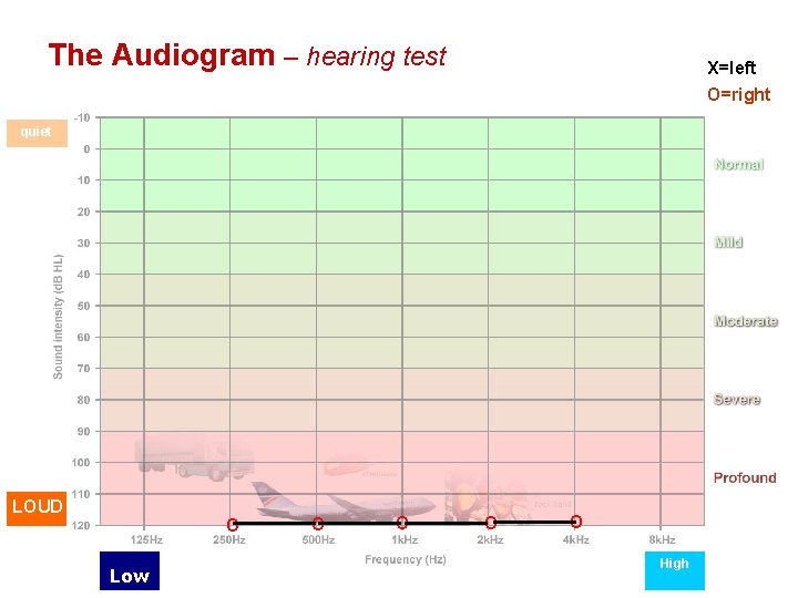 The Audiogram – hearing test X=left O=right quiet LOUD O Low O O High