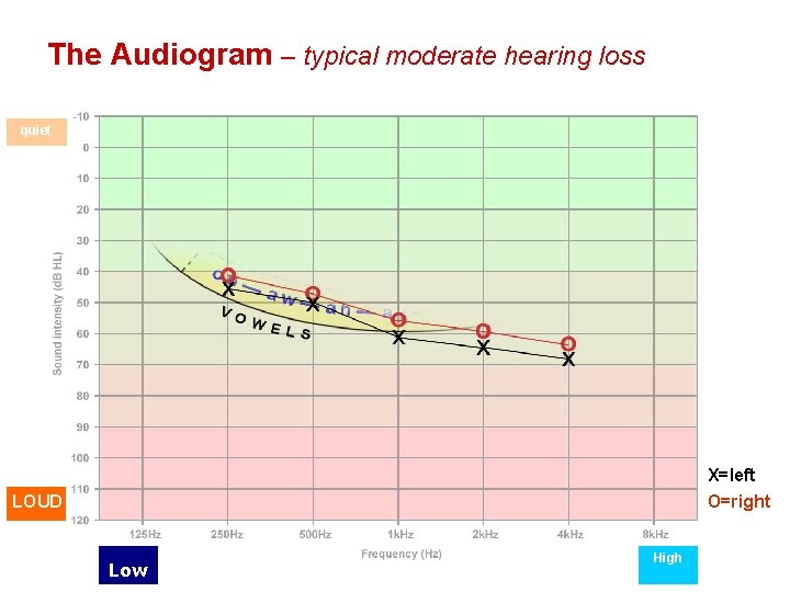 The Audiogram – typical moderate hearing loss quiet X=left O=right LOUD Low High 