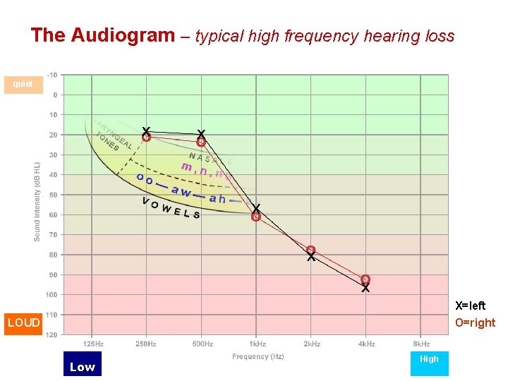 The Audiogram – typical high frequency hearing loss quiet X=left O=right LOUD Low High