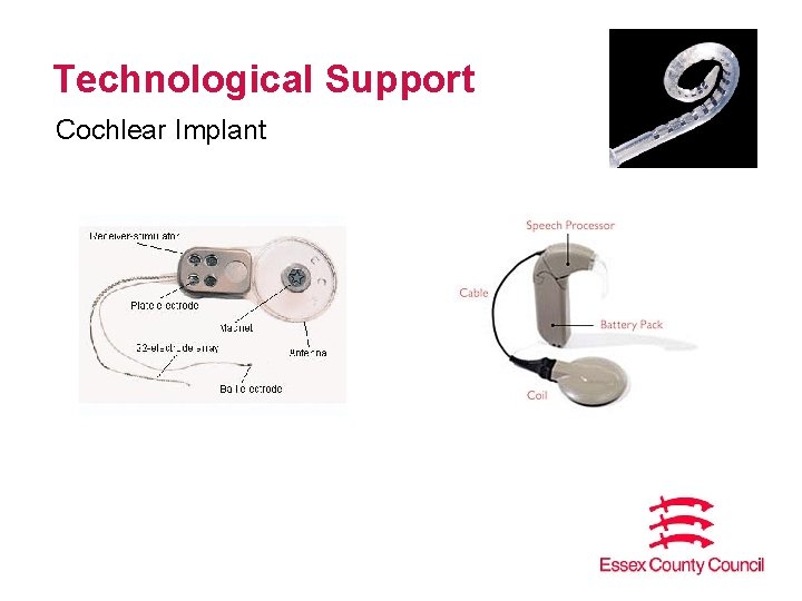 Technological Support Cochlear Implant 