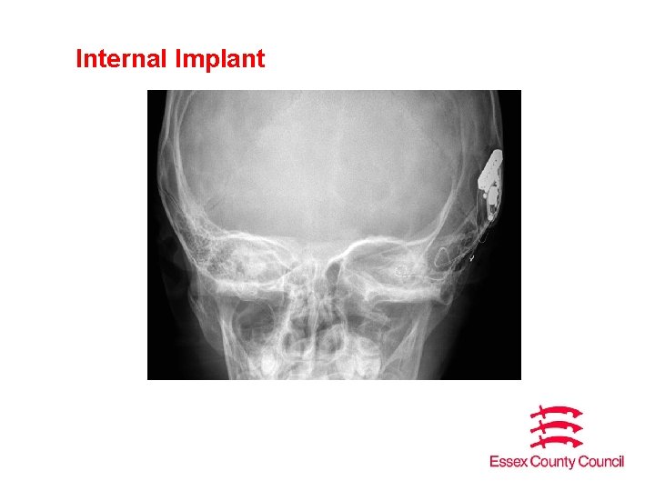 Internal Implant 