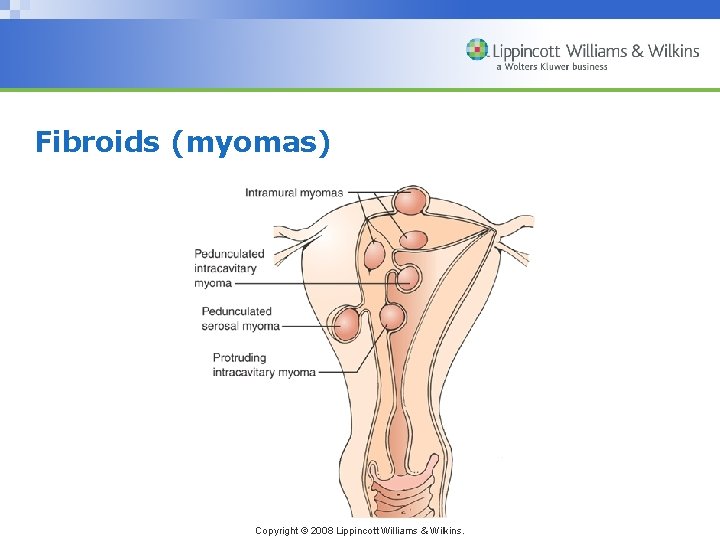 Fibroids (myomas) Copyright © 2008 Lippincott Williams & Wilkins. 
