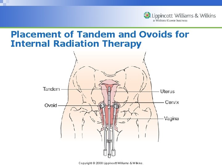 Placement of Tandem and Ovoids for Internal Radiation Therapy Copyright © 2008 Lippincott Williams