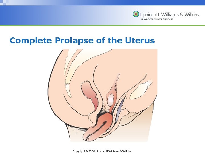 Complete Prolapse of the Uterus Copyright © 2008 Lippincott Williams & Wilkins. 