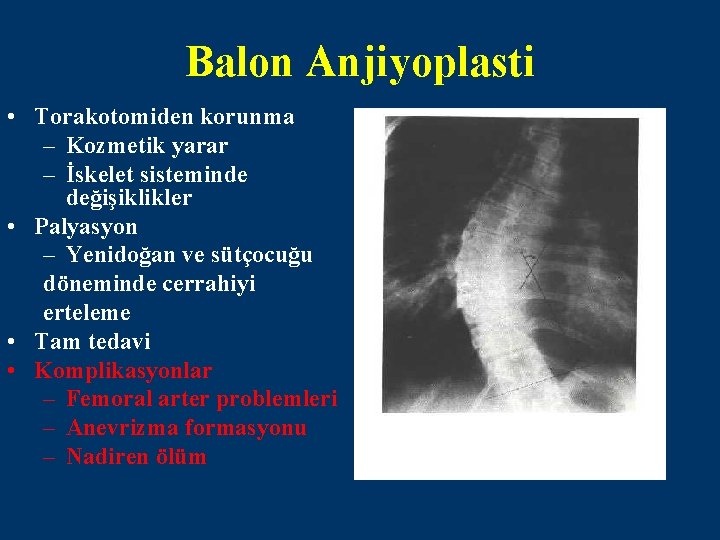 Balon Anjiyoplasti • Torakotomiden korunma – Kozmetik yarar – İskelet sisteminde değişiklikler • Palyasyon