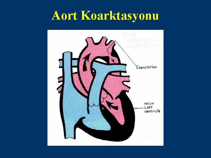 Aort Koarktasyonu 