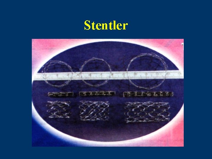Stentler 