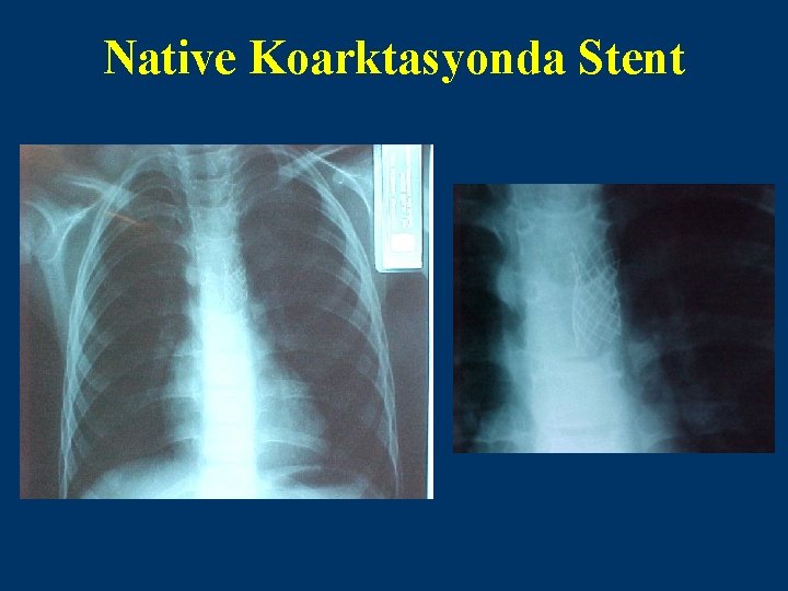 Native Koarktasyonda Stent 