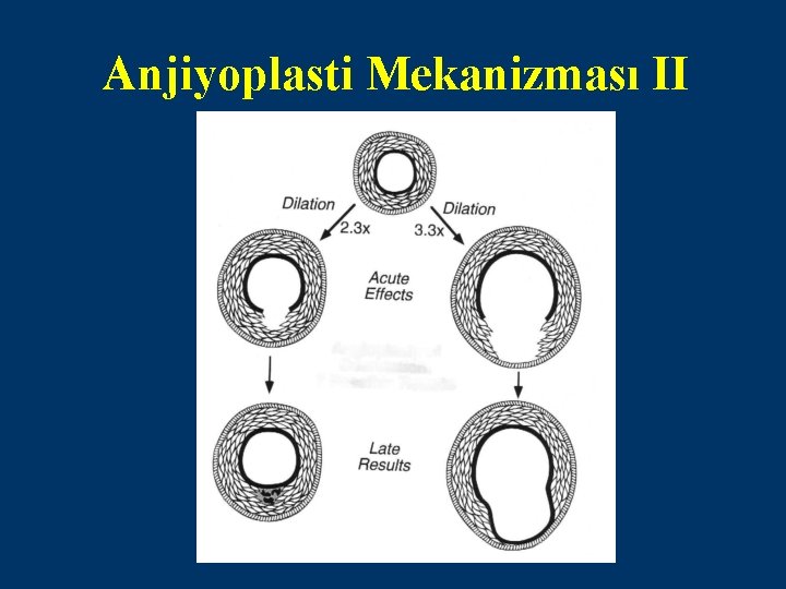 Anjiyoplasti Mekanizması II 