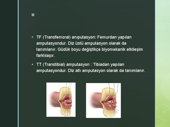 z § TF (Transfemoral) anıputasyon: Femurdan yapılan amputasyondur. Diz üstü amputasyon olarak da tanımlanır.