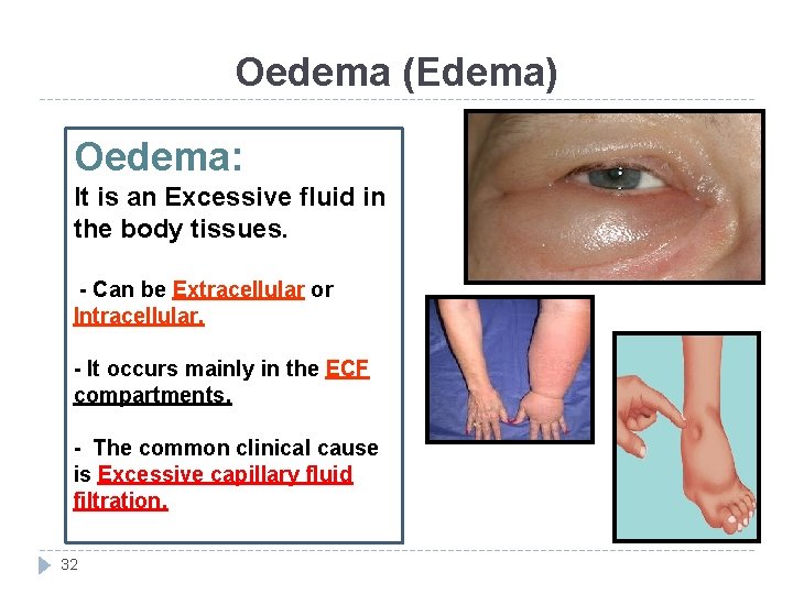 Oedema (Edema) Oedema: It is an Excessive fluid in the body tissues. - Can