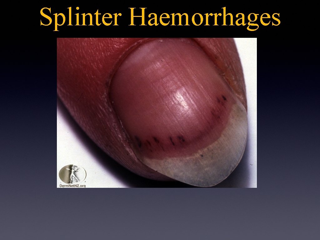 Splinter Haemorrhages 