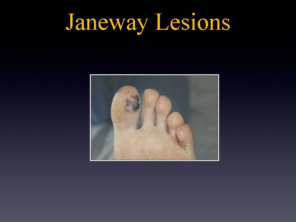 Janeway Lesions 