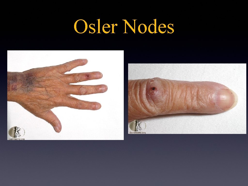 Osler Nodes 