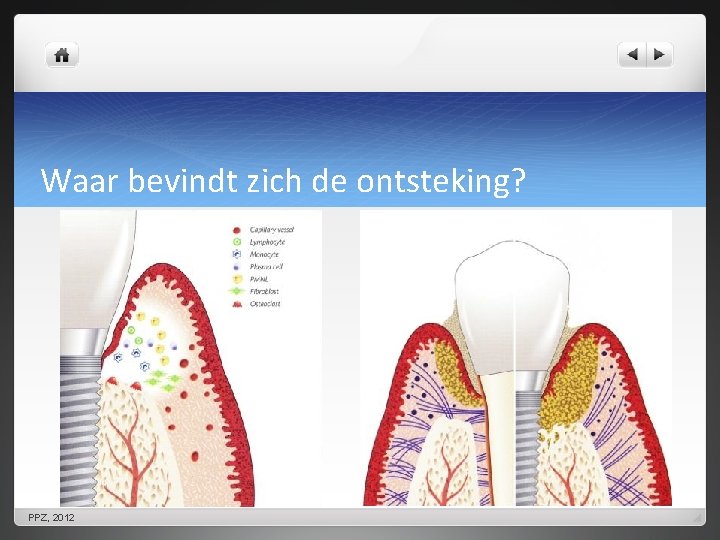 Waar bevindt zich de ontsteking? PPZ, 2012 