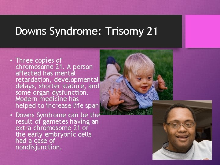 Downs Syndrome: Trisomy 21 • Three copies of chromosome 21. A person affected has