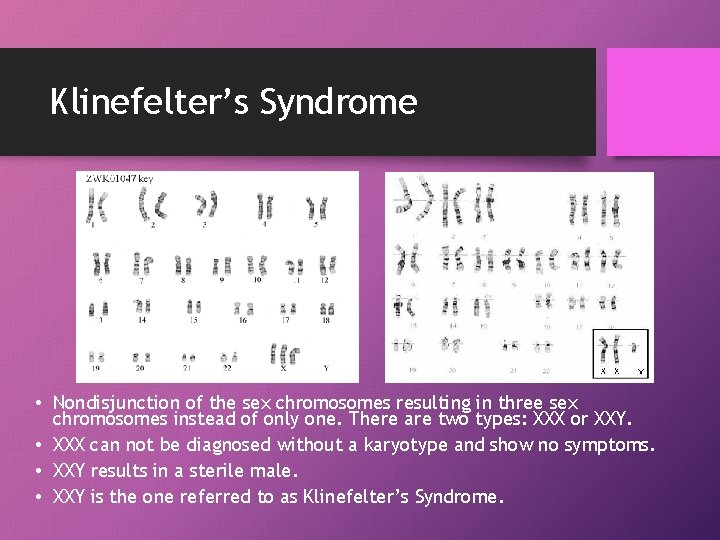 Klinefelter’s Syndrome • Nondisjunction of the sex chromosomes resulting in three sex chromosomes instead
