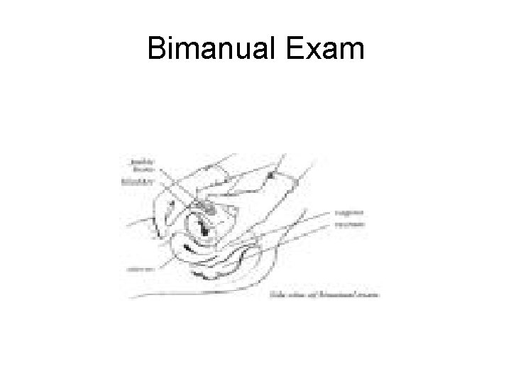 Bimanual Exam 