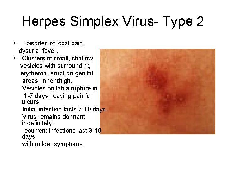 Herpes Simplex Virus- Type 2 • Episodes of local pain, dysuria, fever. • Clusters