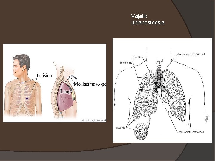 Vajalik üldanesteesia 