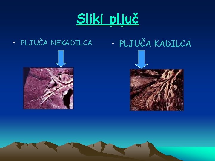 Sliki pljuč • PLJUČA NEKADILCA • PLJUČA KADILCA 