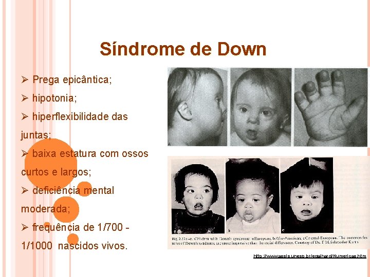 Síndrome de Down Ø Prega epicântica; Ø hipotonia; Ø hiperflexibilidade das juntas; Ø baixa