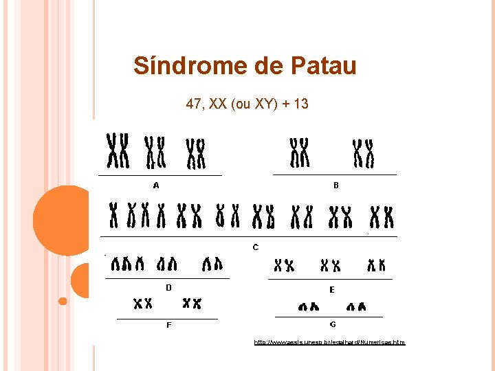 Síndrome de Patau 47, XX (ou XY) + 13 http: //www. assis. unesp. br/egalhard/Numericas.