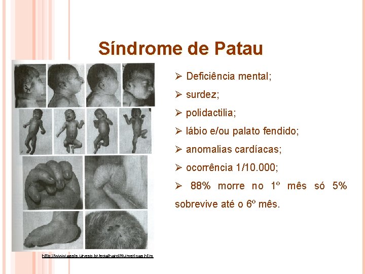 Síndrome de Patau Ø Deficiência mental; Ø surdez; Ø polidactilia; Ø lábio e/ou palato Síndrome de Patau Ø Deficiência mental; Ø surdez; Ø polidactilia; Ø lábio e/ou palato
