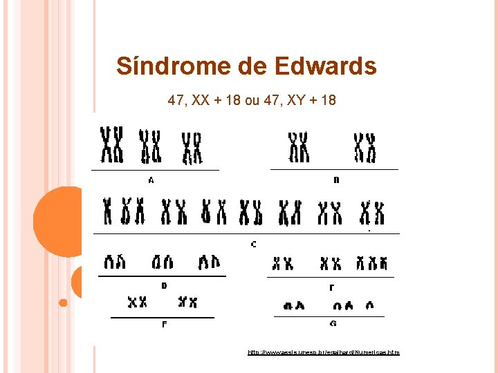 Síndrome de Edwards 47, XX + 18 ou 47, XY + 18 http: //www.