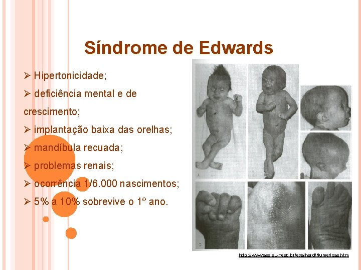 Síndrome de Edwards Ø Hipertonicidade; Ø deficiência mental e de crescimento; Ø implantação baixa