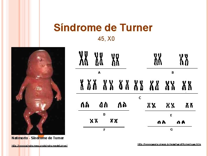 Síndrome de Turner 45, X 0 Natimorto - Síndrome de Turner http: //www. sindromes.