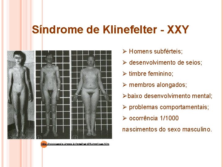 Síndrome de Klinefelter - XXY Ø Homens subférteis; Ø desenvolvimento de seios; Ø timbre